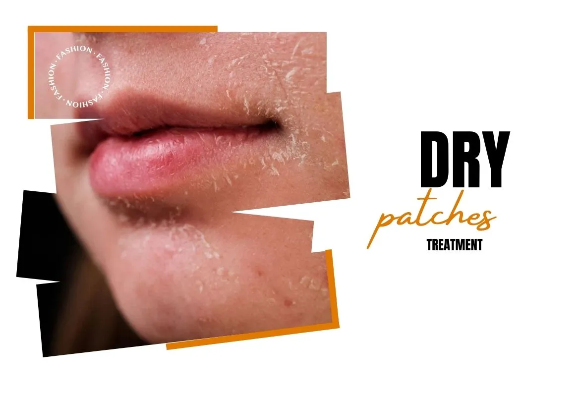 How to Deal with Dry Patches in Winter